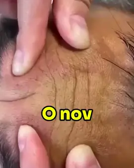 LINK NO MEU PERFIL!! #Rugas #AntiRugas #LinhasDeExpressão #PeleJovem #Rejuvenescimento #Colágeno #Skincare #PeleSemRugas #BelezaNatural #CuidadosComAPele #PeleRadiante #FlacidezNuncaMais #ÁcidoHialurônico #EstéticaFacial #HidrataçãoProfunda #TratamentoFacial #RejuvenescimentoFacial #MáscaraAntiRugas #PeleFirme #DicasDeBeleza #SkincareAntienvelhecimento #DermatologiaEstética #Autocuidado #BelezaSaudável #RugasNuncaMais