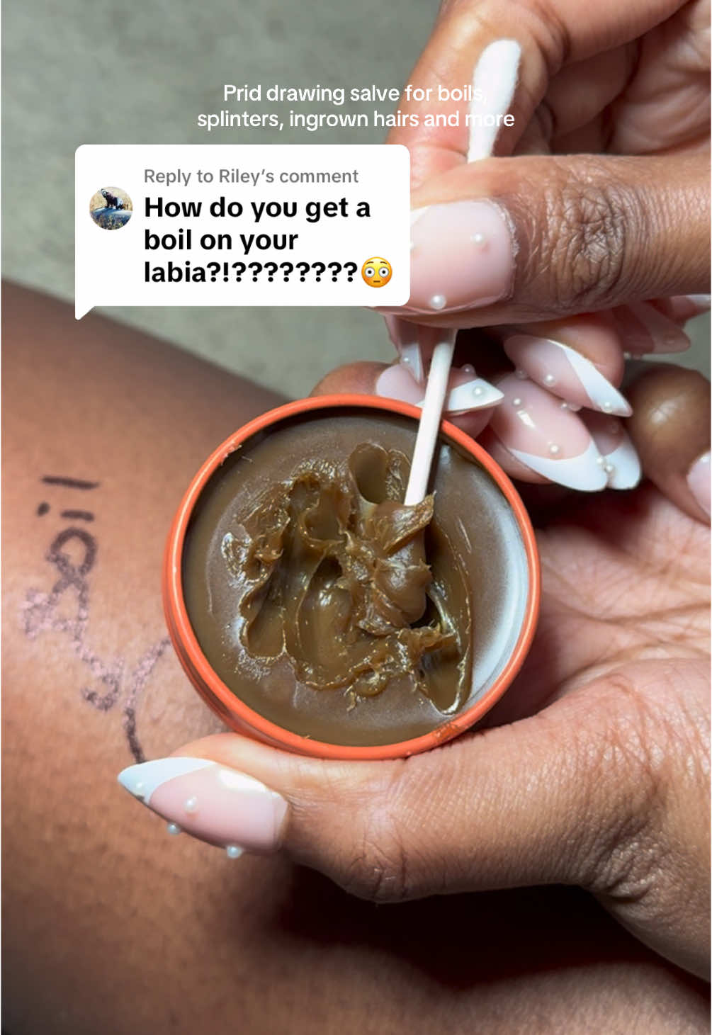Replying to @Riley boils can form on different parts of the body. That’s why this salve is so popular because it helps to drain boils. #prid #drawingsalve #salve #splinterremoval #cysticacne #pridsalvecysticacne #pridsalve #boilrelief #skincare #skintips #painrelief #painrelief #cuts #ingrowns #ingrownhairs #ingrownremoval #ingrownrelief #boil #boilremoval