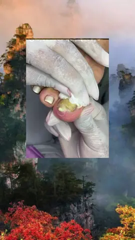 #toenails #ingrowntoenail #toenailremoval #nails #toenail #satisfyingvideos #fyp