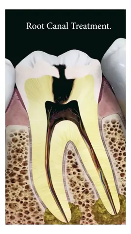 Root Canal Treatment (Perawatan Akar Gigi) Perawatan yang dilakukan pada gigi dengan pulpa terinfeksi (pulpitis) atau mati (nekrosis pulpa) untuk menyelamatkan gigi agar tetap dapat bertahan di dalam rongga mulut. #dentalcare #gigi #perawatangigi #rootcanal #rootcanaltreatment