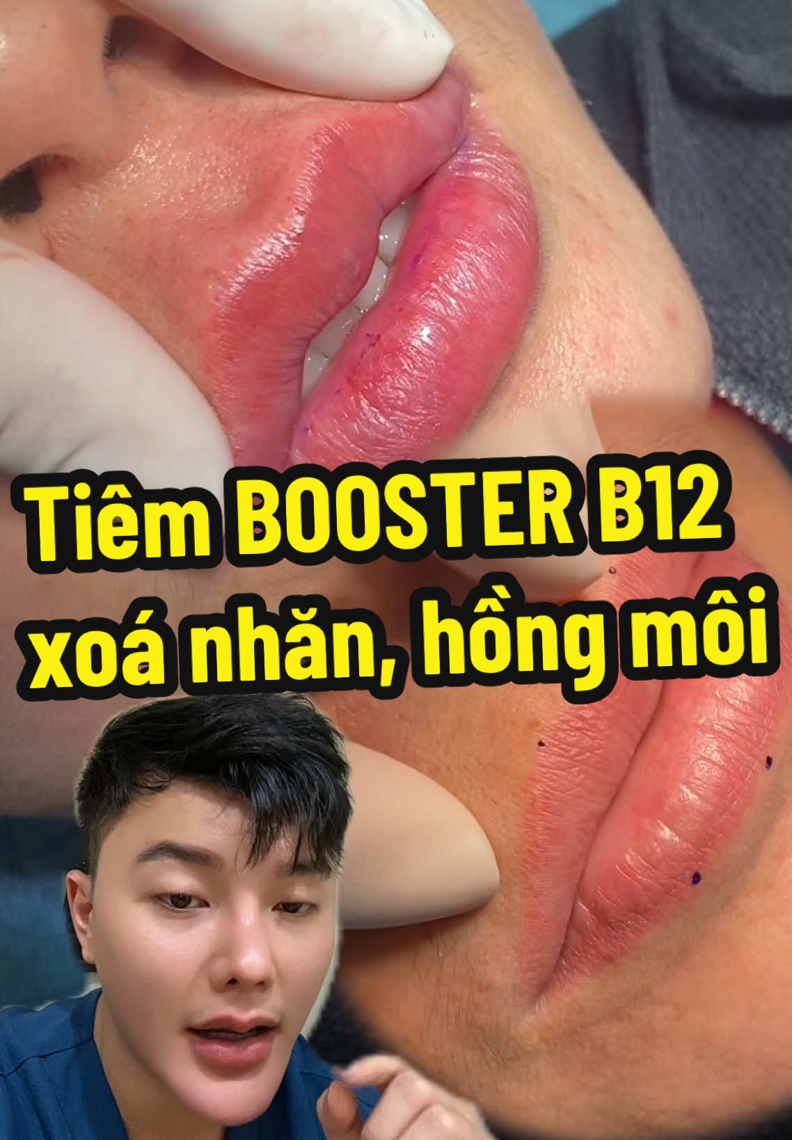 @Ngô Đồng Chia Sẻ Làm Đẹp tiêm booster vitamin b12 vào môi giúp môi ửng hồng tự nhiên, căng bóng và hết nếp nhăn môi  #ngodongreviewlamdep #ngodongcatmoi #tiemfillermoi #purilips #tiemhongmoi #tiemxoanhanmoi 