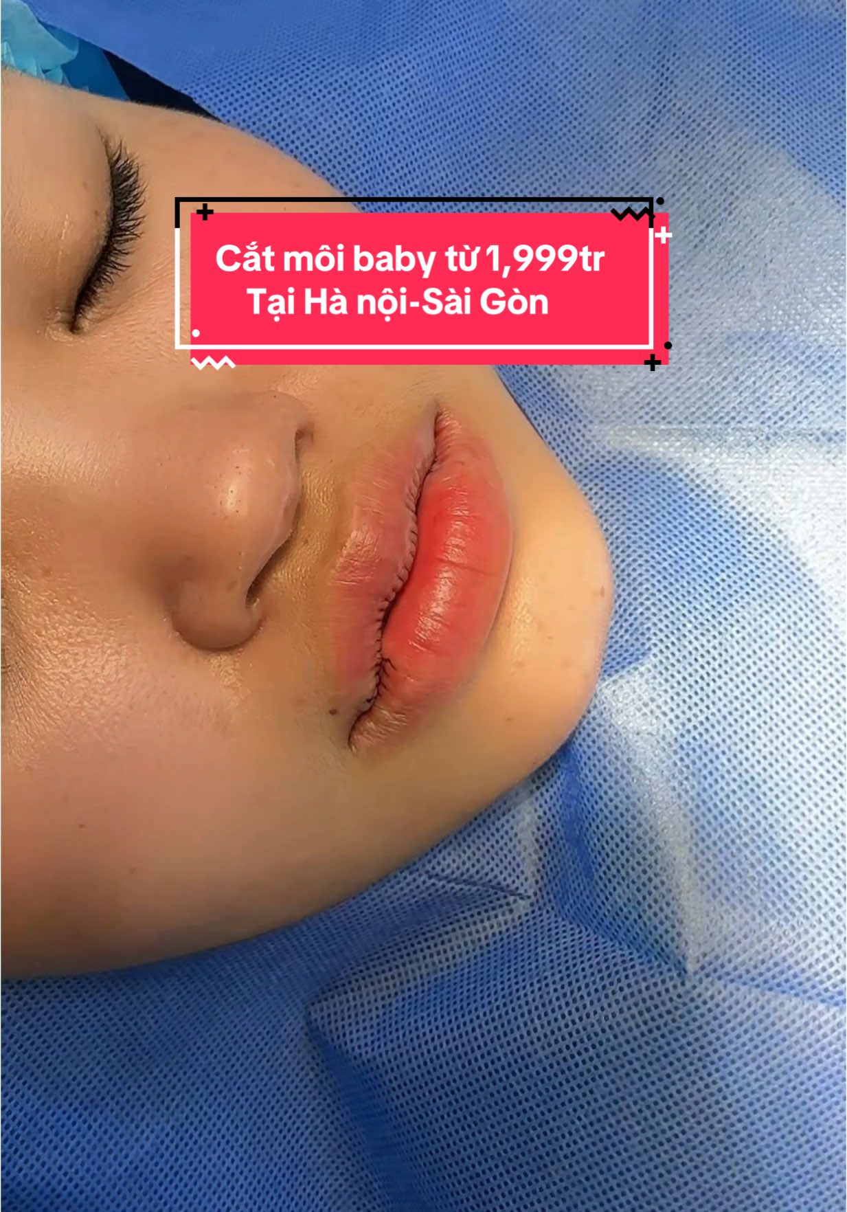 Cắt môi baby từ 1,999tr      Tại Hà nội-Sài Gòn #trending #cătmoitim #cắtminideep 