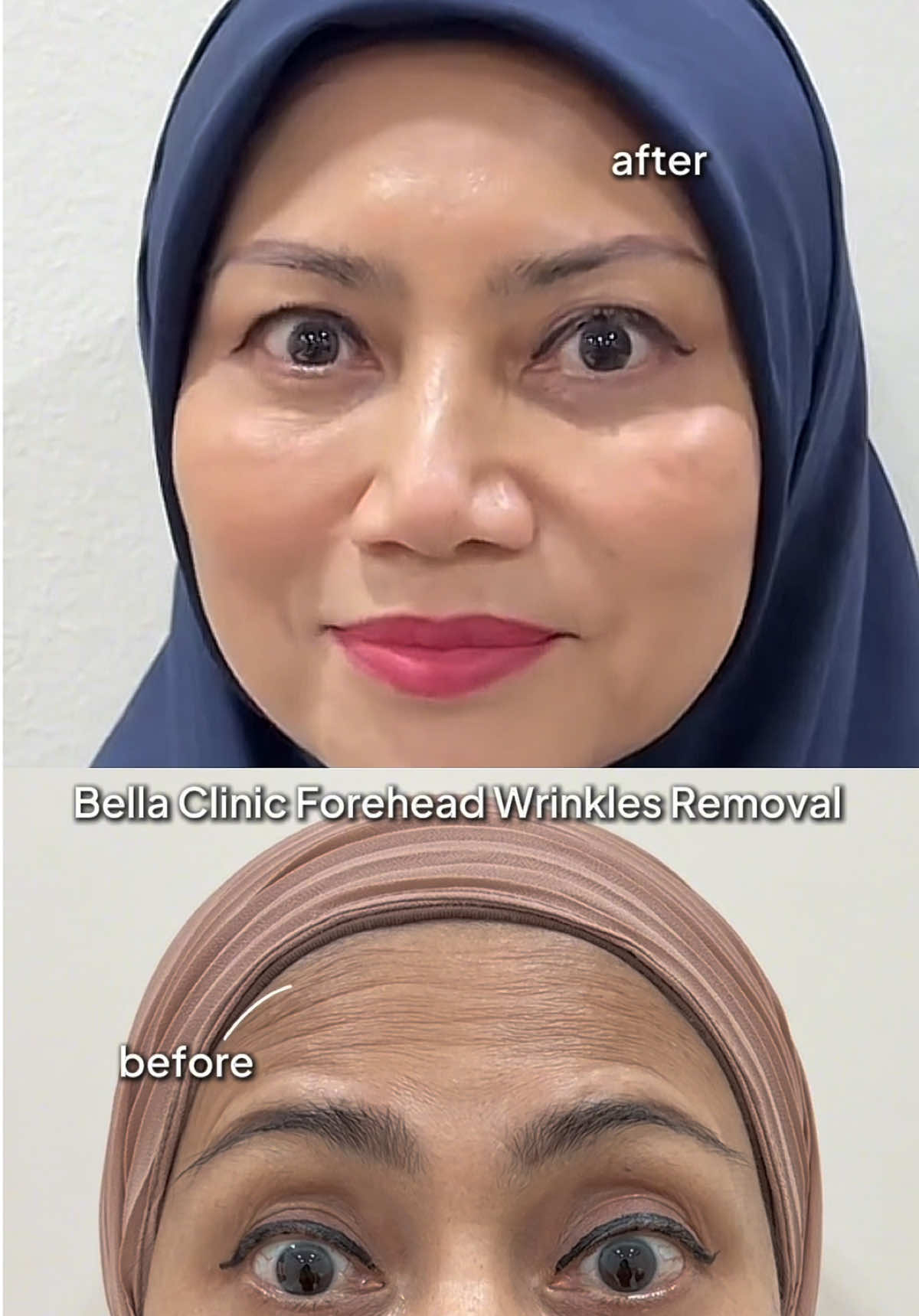 Kedutan dahi hilang dengan rawatan hanya 5 minit sahaja. Rawatan ini juga anti penuaan✨ #bellaclinicmy #bellaclinic #fyp #bellaclinicsripetaling 