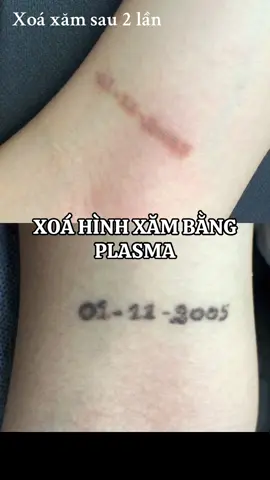 Xoá hình xăm mini siêu sạch [ 𝐎𝐩𝐞𝐧 𝐃𝐚𝐢𝐥𝐲 ] : 8:00AM - 22:00PM  [ 𝐀𝐝𝐝𝐫𝐞𝐬𝐬 ]: Ngô Thì Nhậm - An Khánh - Cần Thơ         𝚃𝚑𝚊𝚗𝚔 𝚢𝚘𝚞 𝚏𝚘𝚛 𝚌𝚑𝚘𝚘𝚜𝚒𝚗𝚐 𝚞𝚜 💌 #phunmoicantho #Hairstroke #Plasma_môi #phunmay #khử_thâm_môi_nam #Khử_thâm_môi_tự_nhiên #Laser_xoá_mày_hỏng #nhiphunxam #chanmayphongthuy #Điêu_khắc_lông_mày #phunxamthammycantho #ĐÀO_TẠO_HỌC_VIÊN_CẤP_TỐC