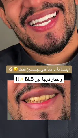 هوليود ايماكس ، ابتسامة المشاهير ، اسنان بيضاء ، اسنان ، ابتسامة المشاهير ، هوليود سمايل  عدسات الايماكس (3D ( vip نوعها الماني وعليها ضمان 5 سنوات تعالج الاتي :  ١- فقد في الاسنان  ٢- التصبغات والاصفرار  ٣- الكسور البسيطة للأسنان  ٤- التباعد والفراغات بين الاسنان - ⁠تحاكي الآسنان الطبيعية على حسب رغبتكم واختياركم للشكل واللون والشفافية  وللحجز والاستفسار الرجاء التواصل عبر الواتساب بالرقم : 0552026694 او الاتصال بالرقم الموحد : 920014158 #اسنان #ابتسامة_هوليود #dental #foryou #السعودية🇸🇦 #جده #يوم_التأسيس @عيادات البا للابتسامة @alba medical tv  @اميره  @coach_fatmah 