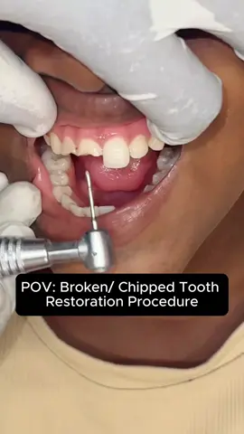 A fiber post is used during a dental filling procedure to strengthen a tooth that has undergone root canal treatment, particularly when significant tooth structure has been lost. Get your broken tooth restored with us today. #compositefilling #compositebonding #viral #fyp #kenya