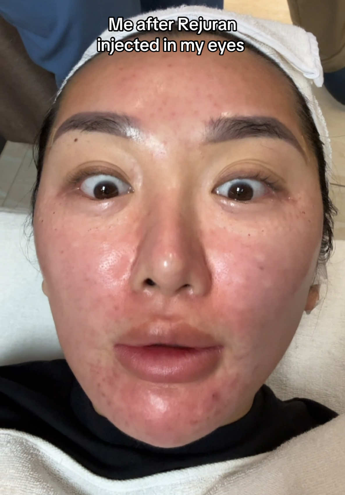 Going to stitch this video after healing 🤣 the full breakdown on YT #skintreatments #korea #skinlasers #skinlasertreatment @Lamiche Dermatology 