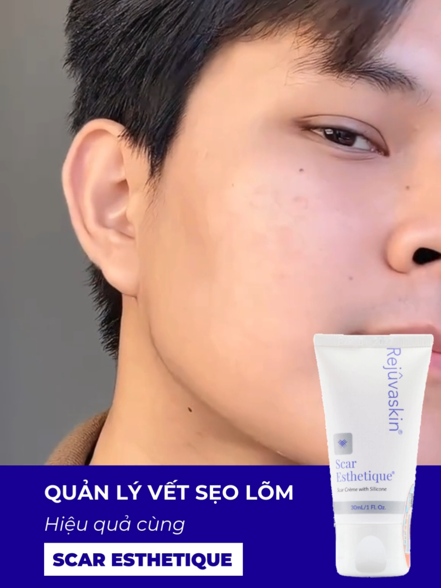 Hiệu quả của việc sử dụng kem mờ sẹ.o thâm rỗ lõm sau 1 thời gian sẽ như thế nào? #rejuvaskinvietnam #rejuvaskin #rejuvasil #kemtriseo #scaresthetique #silicone #seoloi #scarfx #facialcleanser #suaruamat