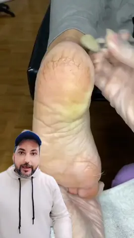 علاج تشققات القدمين  #تشققات_القدمين #القدم #خلطات  #اكسبلور  #ترند#خلطات 