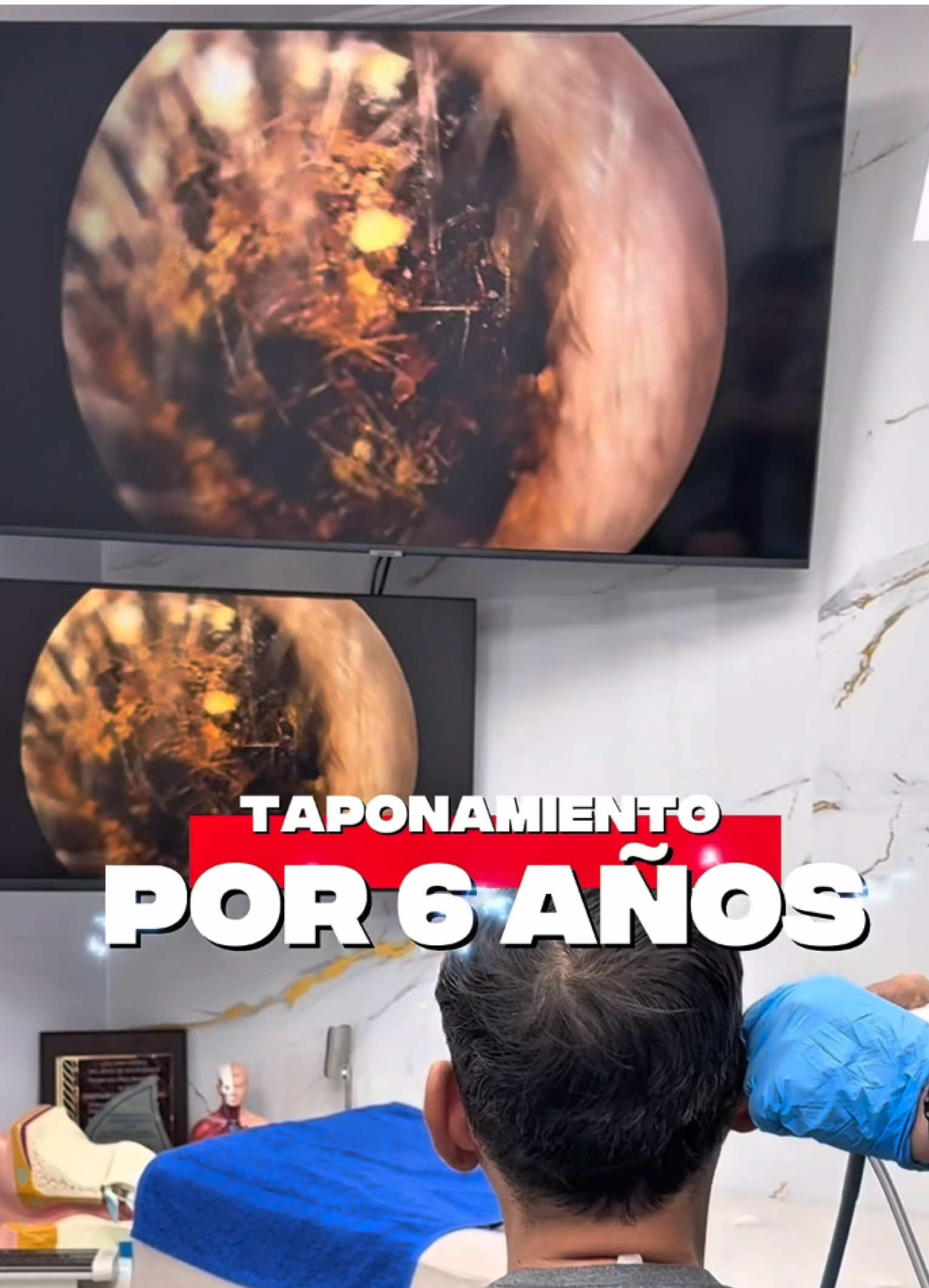 #cemdin #oidostapados #oidos #drchristiancajasc #salud #especialista #otorrino #guayas #oido #doloroido #ecuador🇪🇨 #oidoslimpieza #tinnitus #audiologiaclinica #oidolimpio #medico #oidoniño #