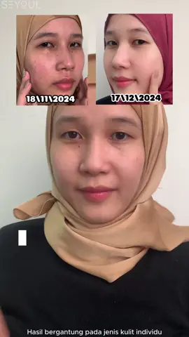 30 hari transformasi kulit – Hasil dari Bubble Toner Seyoul pasti buat anda terkejut!