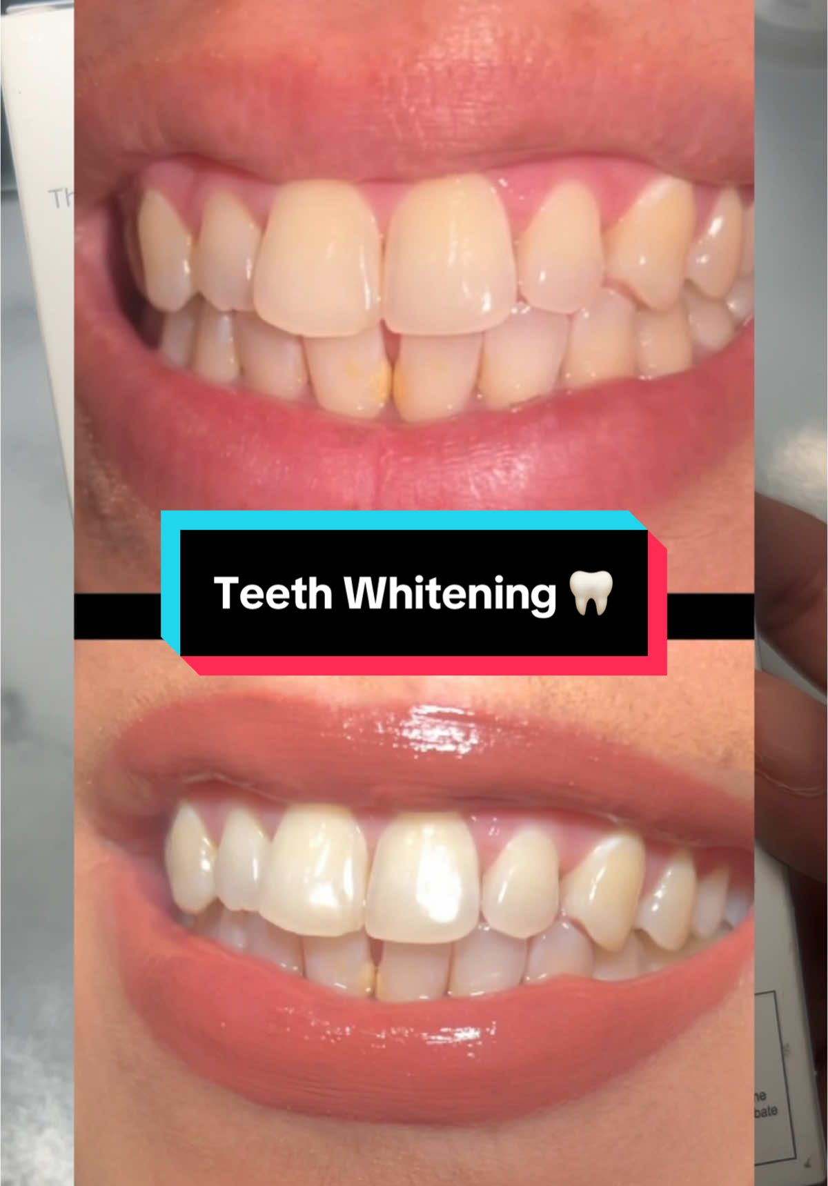 Gifted by supersmile  @supersmileofficial  Get 25% off with using “SMILE25” These strips are Vegan, clean, kosher & gluten free  They are also free of parabens, sulfates and harsh bleaching agents   #supersmile #superstrips #teethwhiteningstrips #teethwhiteningathome #teethwhiteningkit #teethwhitening