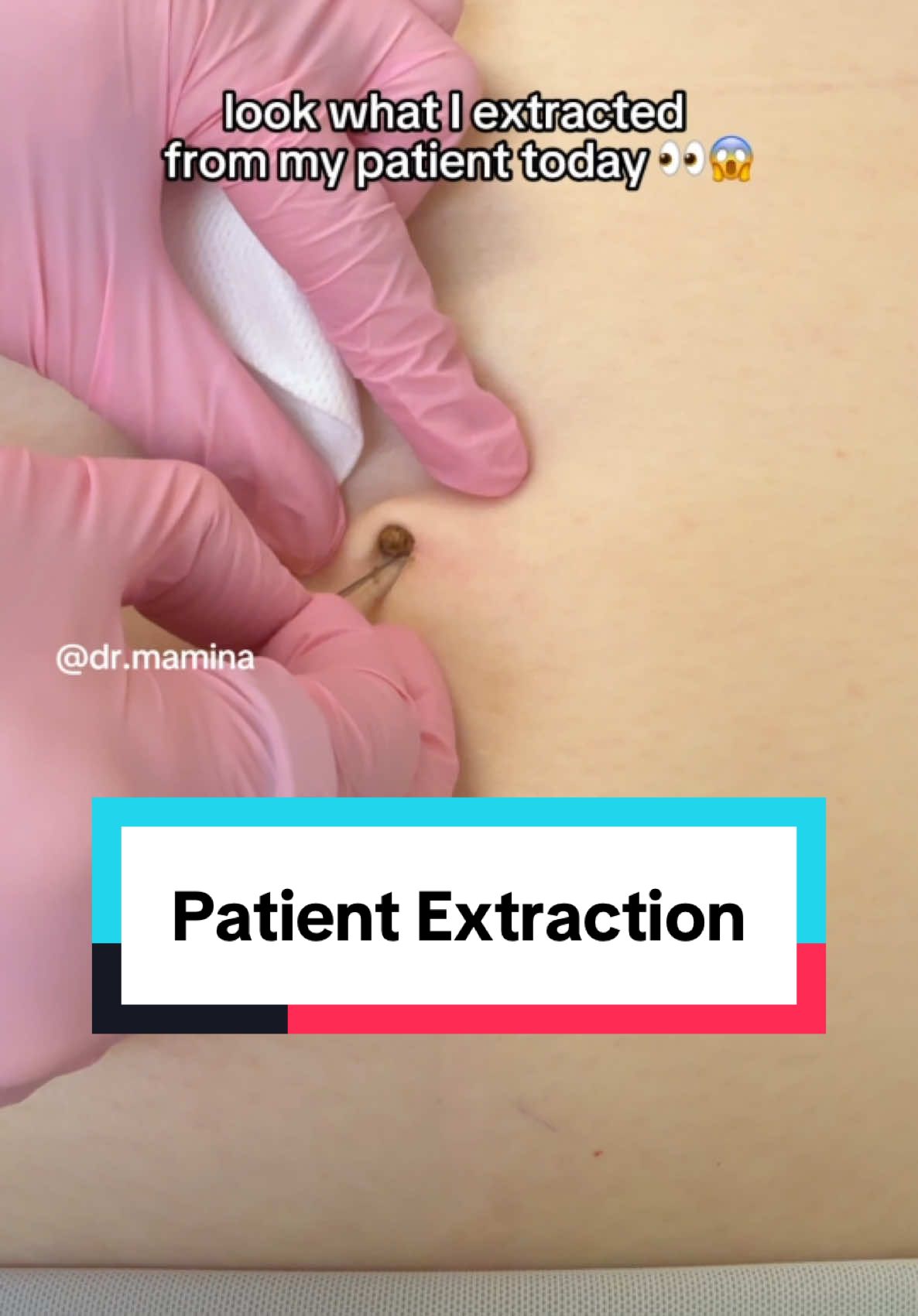When I posted this on my stories, over 5,000 of you thought it was a cutaneous horn, but turns out it actually is an omphalolith (aka navel stone). This takes years to form and it is essentially a build up of dead belly button skin cells. This patient said her OBGYN tried to remove it but was having a difficult time. I said OOOHHHH you’ve come to the right place 😄  Want more extraction videos? 👀