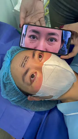 Chinh đẹp đến thế này thôi, pp cải thiện tình trạng bọng mắt mỡ da dư 2-3 bọng đường khâu siêu mịn ✅ #xuhuong #lamdepkhongkho I 