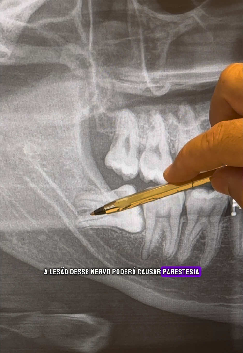 A extração do siso é indicada sempre quando ele nasce em um ângulo errado, quando não possui função mastigatória, quando atrapalha na mordida e compromete a higienização e o alinhamento de outros dentes. Há casos em que o dente do siso fica incluso e no osso (não nasce). Nestes casos indica-se a extração, na maioria das vezes, afim de previnir cistos e reabsorção de raizes de dentes adjacentes.  ————————————— Esta publicação está em acordo com a resolução CFO-196/2019. Cabe informar que o resultado atingido não pode servir de padrão ou referência genérica, afinal a odontologia não é uma ciência exata e cada paciente possui características únicas, devendo sempre ser aferido o tratamento adequado caso a caso. ————————————— Dr. Claumir Arcanjo CroSP: 89515 #dor #dente #siso #cirurgias #saudebucal #bragancapaulista #viralvideos 