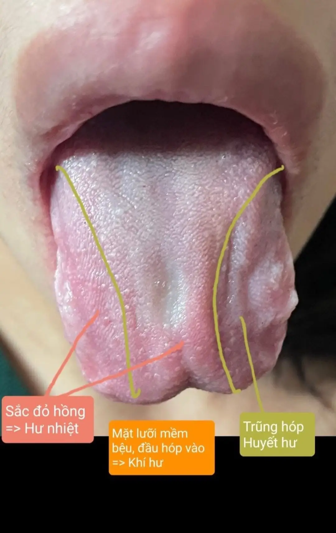 Bệnh nhiều chứng quá đến lúc phục hồi cũng không nhớ được trước đây mình bị gì. 1. Rìa lưỡi lệch trên hóp vào lại trũng thấp xuống  => Huyết hư. 2. Mặt lưỡi thì mềm bệu, đầu lưỡi hóp vào  => Khí hư 3. Người nóng, đắng miệng, nhiệt miệng lưỡi đỏ hồng mà hơi sẩm => Hư nhiệt. Thường người khí huyết hư hình lưỡi đa số là thon nhỏ dẹp, lưỡi nhợt không rêu ít rêu. Nhưng đây là lưỡi hơi thiên to bệu là vì của sản hậu, cái gốc ban đầu khí huyết đầy đủ chứ ko phải hư, do sau sinh huyết mạch hư rỗng, âm huyết hư mạch bị rỗng nên mặt lưỡi bị trũng thấp; huyết hư mà dương khí còn nên dương khí bốc lên mà phát nóng nên lưỡi đỏ hồng; khí bốc lên hao tán ra ngoài nên dần dần khí hư theo mà mặt lưỡi mềm yếu, khí lên não kém làm đầu lưỡi hóp vào trong. Hình lưỡi này mạch đa số là mạch đại mà hư vô lực. Nhưng không phải chứng của Bổ trung ích khí, hay Bạch hổ gia nhân sâm thang mà là chứng của Thánh dũ thang, do huyết hư phát sốt. Bệnh nhân đang nặng về tâm, tâm hoảng thần bất an, lưỡi cũng trũng hóp nặng vùng rìa trên, nghĩa là ống mạch phía đầu trên đang hư rỗng nặng hơn nên gia thêm Mạch môn giảm Thục địa (đầu dưới) đổ âm dịch thượng tiêu tâm phế, Chích cam thảo bổ tâm khí cùng thuốc thanh hư nhiệt, liễm tâm an thần mà thu được hiệu quả.  Vị Viễn chí mọi người có thể dùng, thân dạng ống tựa Ba kích không chỉ định tâm an thần ở trên mà còn ống rỗng giao thông tâm xuống thận, nhưng vị này trị ngọn lại đắt tiền, hiệu quả không quá rõ ràng nên mình không dùng. Phương thuốc trêm dùng Táo nhân nam, và Mạch môn nam giúp giảm chi phí cho bệnh nhân mà hiểu quả không quá khác biệt.