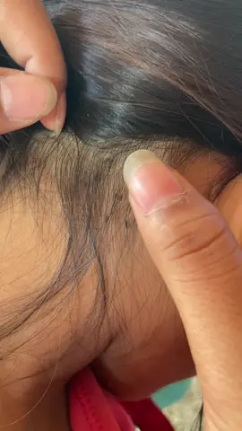 oh not too many lice 😱#omg #lice #liceremoval #trending #tiktokindia #satisfatorio 