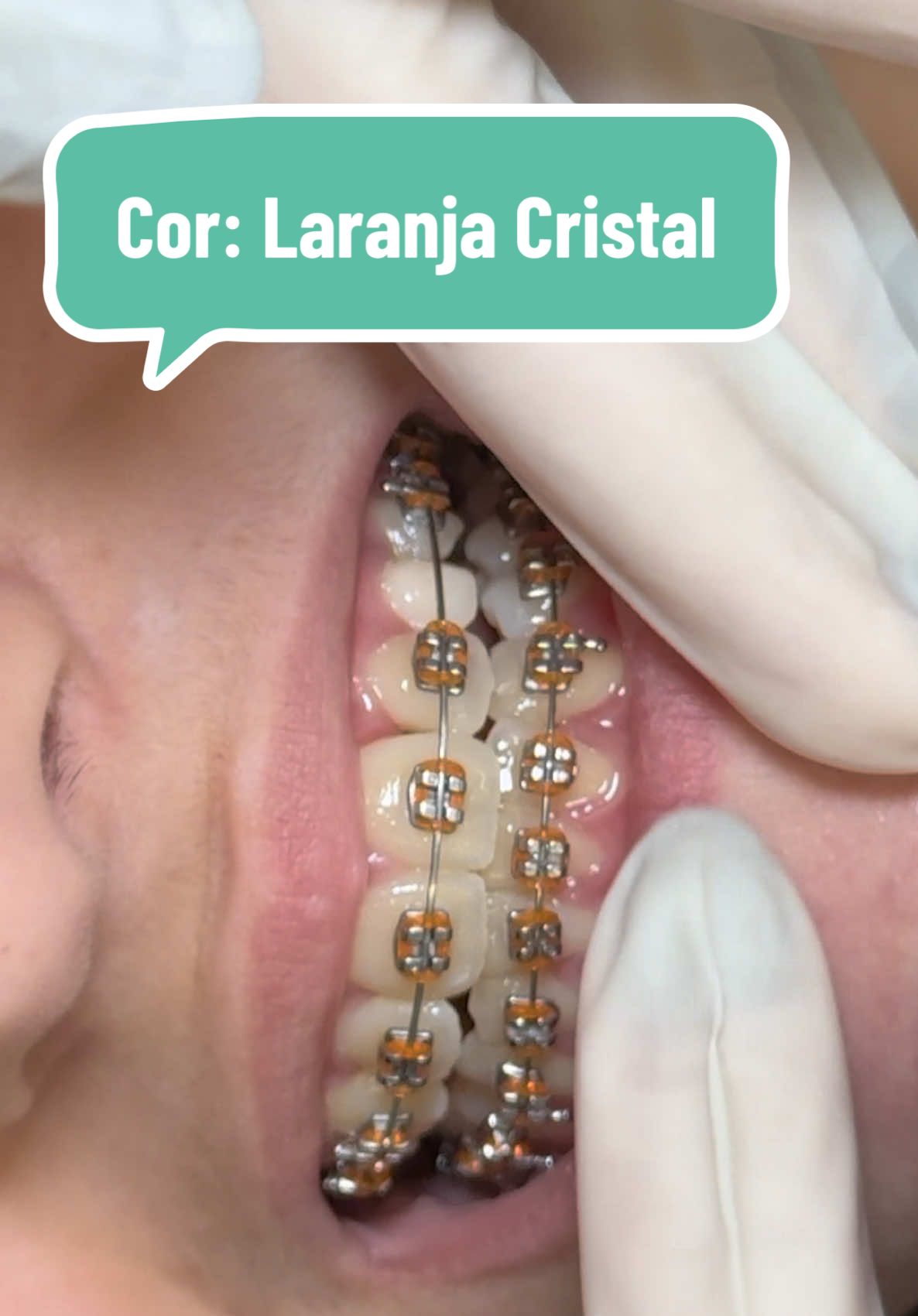 #laranja #orange #colors #aparelhoortodontico #ortodoncia #bracescolors 