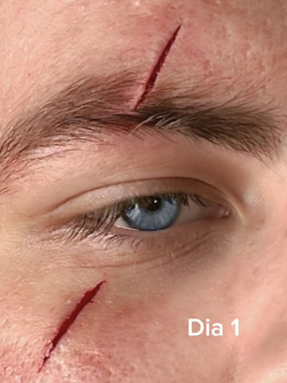 escarificação em cicatrização  #CapCut #modificacaocorporal #scar #scary #scarificationartist 