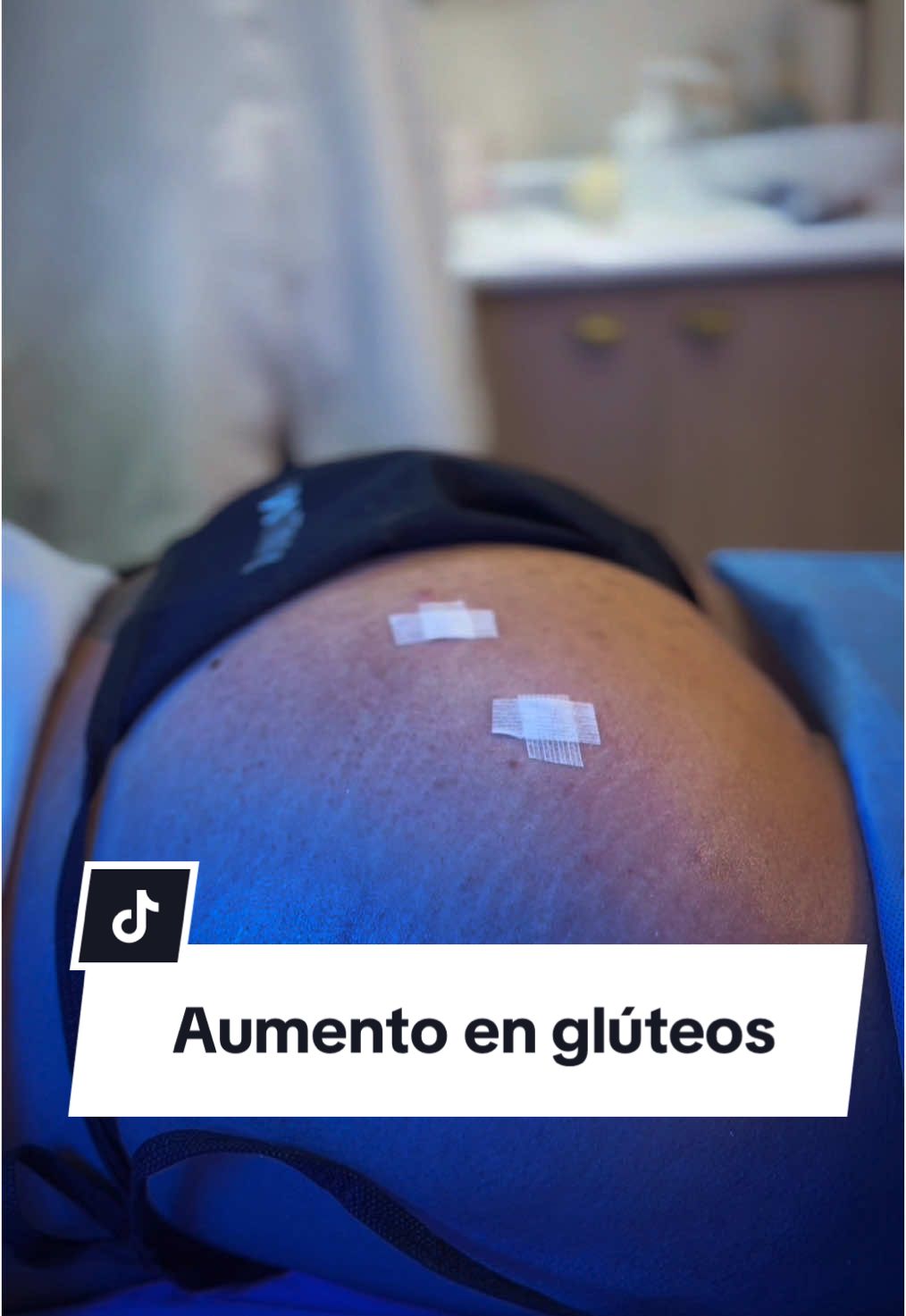 ✨Glúteos más grandes y definidos sin cirugía✨ 💉Con Lanluma, logramos volumen, firmeza y un efecto natural sin bisturí y con resultados inmediatos. ✅ ¿Te animarías a probarlo? ¡Escríbenos y te enviamos toda la info!  #gluteos #volumen #body #aumento #foryou #viral #sanvalentin #Love #parati 