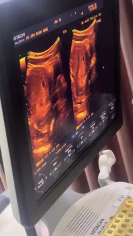 em đến với bố mẹ hơi sớm nhưng k sao , mẹ sẽ cố gắng e cứ khoẻ mạnh đủ ngày đủ tháng ra với mẹ nhé 🥰🫂#xuhuong @Du Nguyễn 