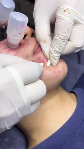 #lấy_nhân_mụn_bằng_tăm_bông #xh 