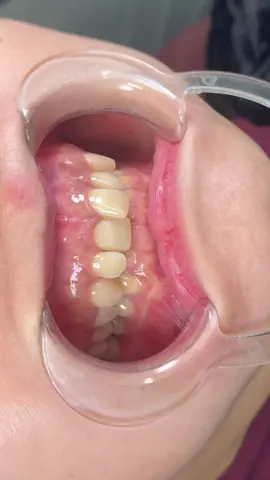 Cải thiện về màu sắc và hình thể răng cho e gái Nam Định#xuhuong #răng_sứ_thẩm_mỹ 