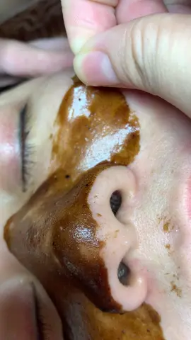 Đãaa #chamsocdamun#chamsocdaseo#chamsocdanam#tanbinh#govap #Le quynh#Lqspa#hocnghespa  #chamsocda #lequynhspa #lequynhspahcm#vienthammylqspa#lqspabeautyacdemy#LQSPABeaty&Acedemy 