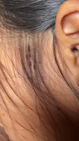 lice removal 😱#omg #lice #liceremoval #treanding 