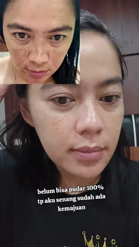 Semangat yu bisa yuuu #pejuangflek #flekhitam  #melasma 
