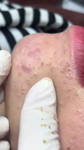 Khách mụn ẩn siêu nhiều ,như khách lại siêu sợ đâu,thêm bé đang niền răng ,nên Jun nặn phải nương tay ở vùng miệng ,mong các bạn xem vui vẻ hoan hỉ 😊#fyp #sinhvien #NguyenJunct #cầnthơ #nanmunchuanykhoacantho #fypシ #trending 