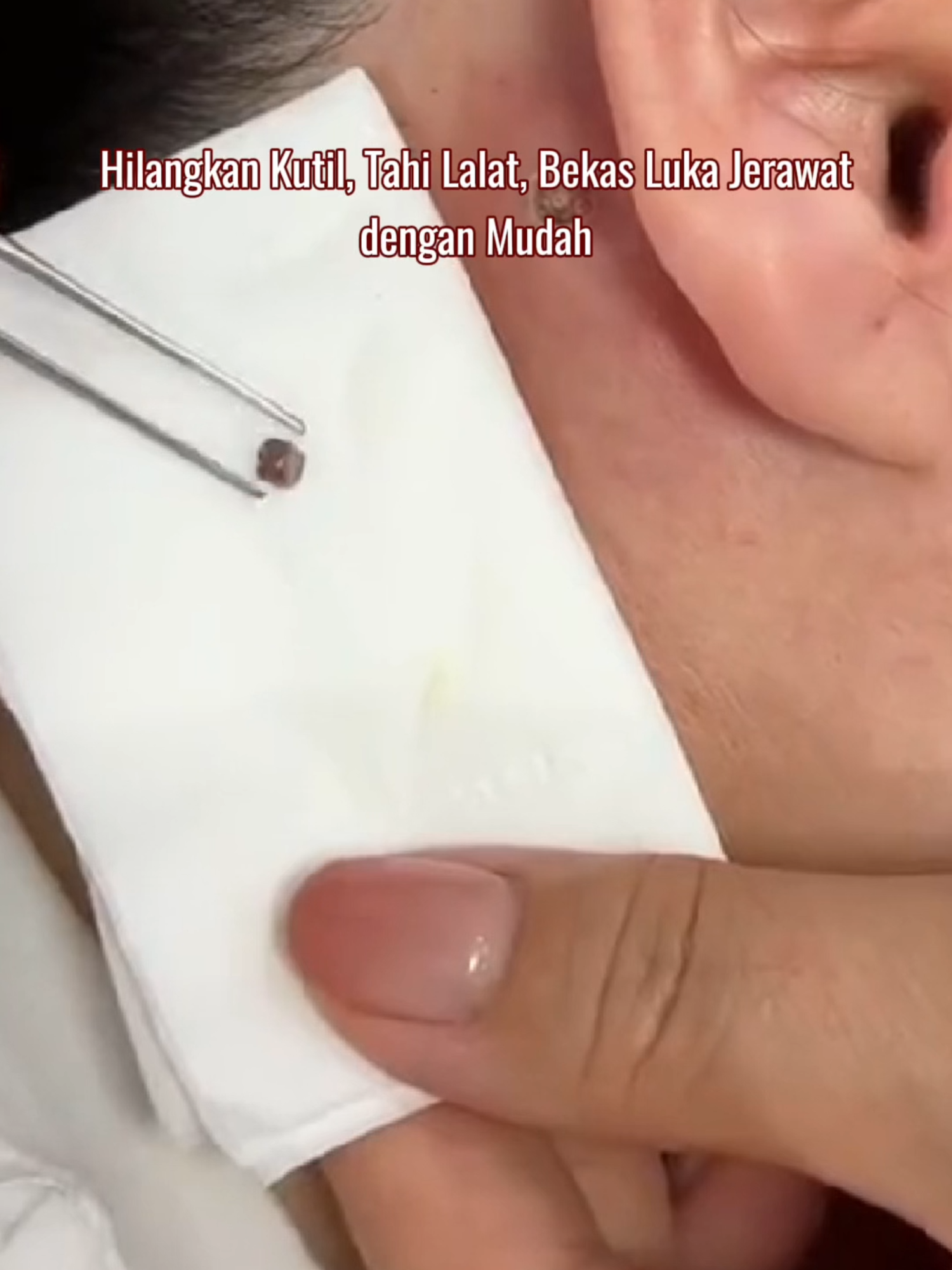 Hilangkan Kutil, Daging tumbuh berlebih, Kapalan, Tahi lala! Dapatkan kulit mulus dan percaya diri dengan TAGS & MOLES REMOVER Gel. Beli sekarang untuk mendapatkan harga terbaik! #tiktok #tiktokindia #tiktokShopIndonesia #promotiktok #tiktokviral