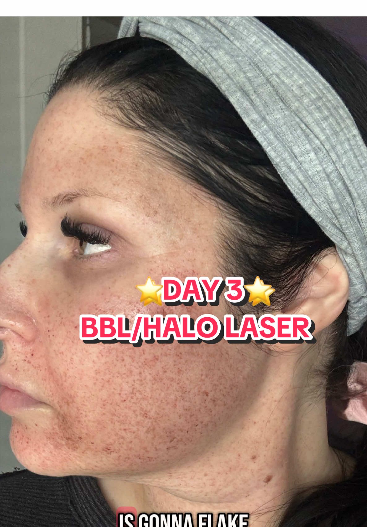 ⭐️DAY 3⭐️ BBL & HALO TREATMENT #austintx #atx #bbl   #Halo #pigmentation #wrinkles #day3 #part3 #westlakefreshaesthetics #journey