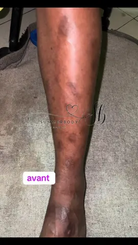 après 2 traitements elle est enfin heureuse 🥰🥰 eliminer les taches noirs tache noir trend tache  produit tache  acné tache noir sur le corps enlever les taches hyperpigmentation eliminer les taches noirs  j'ai une tache Tache jambe #hyperpigmentation #tache #cicatrices  #scar #eliminerlestachesnoires #tachesbrunes 