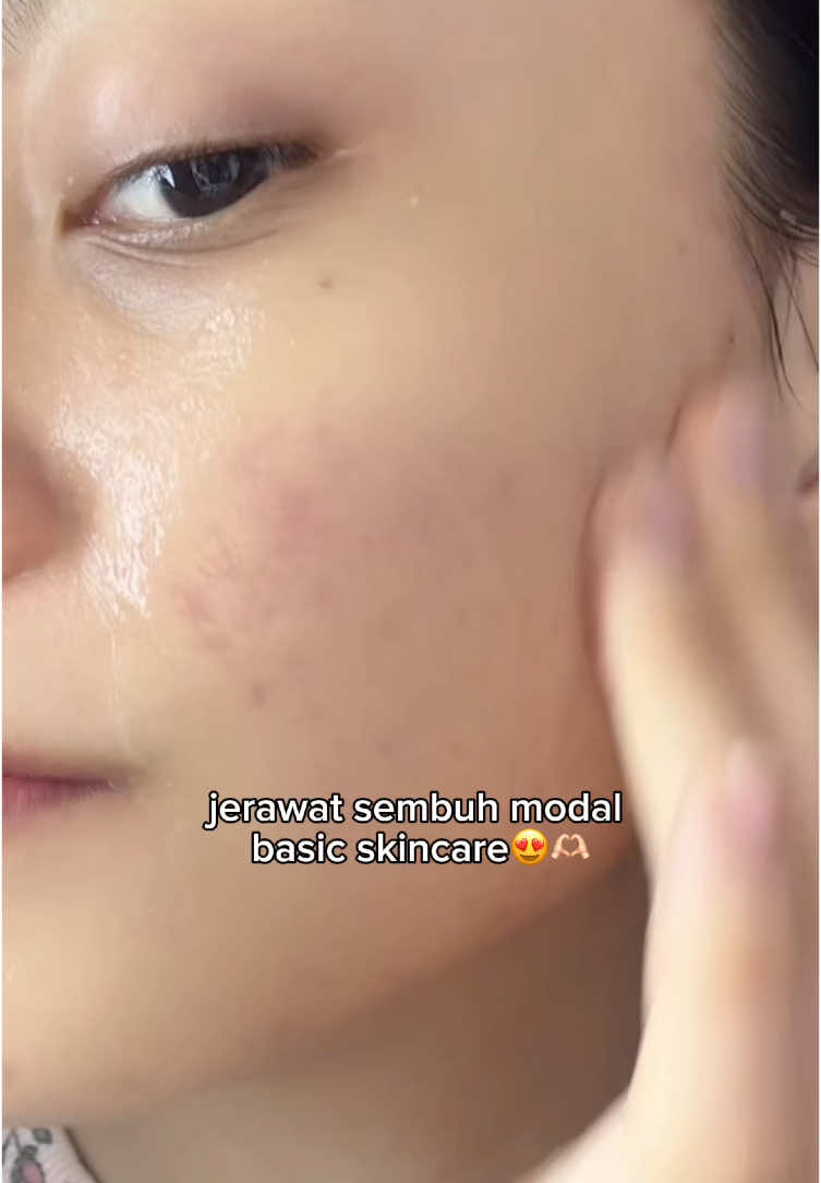 yg ngebantu redahin jerawat & kemerahan🥰 #acnemoisturizer #acnefighter 