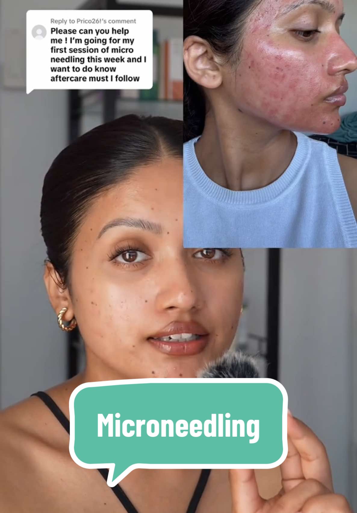 Replying to @Prico26! If you’re getting microneedling, PLEASE don’t skip this step… trust me! 🙈  Products mentioned:- @CeraVe @Cetaphil @La Roche-Posay @anua_global @numbuzin Official @mixsoon_official @Dr Althea @PURITO SEOUL    #ski#skincarec#microneedlinga#healingc#microneedlinghealingi#skincareroutinei#skincareproductsr#barrieri#skinbarriernescars 