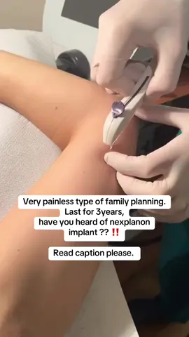 Nexplanon is a small, flexible rod about the size of a matchstick that is inserted under the skin of the upper arm to provide long-term birth control. It releases a hormone called etonogestrel, which prevents pregnancy by stopping ovulation, thickening cervical mucus to block sperm, and thinning the uterine lining to prevent implantation. Key Facts About Nexplanon: ✔ Highly Effective – Over 99% effective in preventing pregnancy. ✔ Long-Lasting – Works for up to three years (can be removed earlier if needed). ✔ Convenient – No daily pills; once inserted, you don’t have to think about it. ✔ Reversible – Fertility usually returns quickly after removal. ✔ Safe for Most People – Can be used by those who can’t take estrogen-based birth control. Possible Side Effects: 	•	Irregular Bleeding (common, especially in the first few months). Some people stop having periods altogether. 	•	Headaches, weight changes, mood swings, breast tenderness (varies by individual). 	•	Insertion Site Issues – Slight bruising, swelling, or pain after insertion, but this usually resolves quickly. Who Can Use Nexplanon? Most healthy women can use Nexplanon, but it may not be suitable for those with a history of blood clots, liver disease, or certain cancers. Always consult a healthcare provider before getting it. Would you consider Nexplanon? Or if you’ve used it before, what was your experience like? Let’s chat in the comments! ⬇️💬. .  #Nexplanon #implant #familyplanning #nursetrendy #fyp #relatable 
