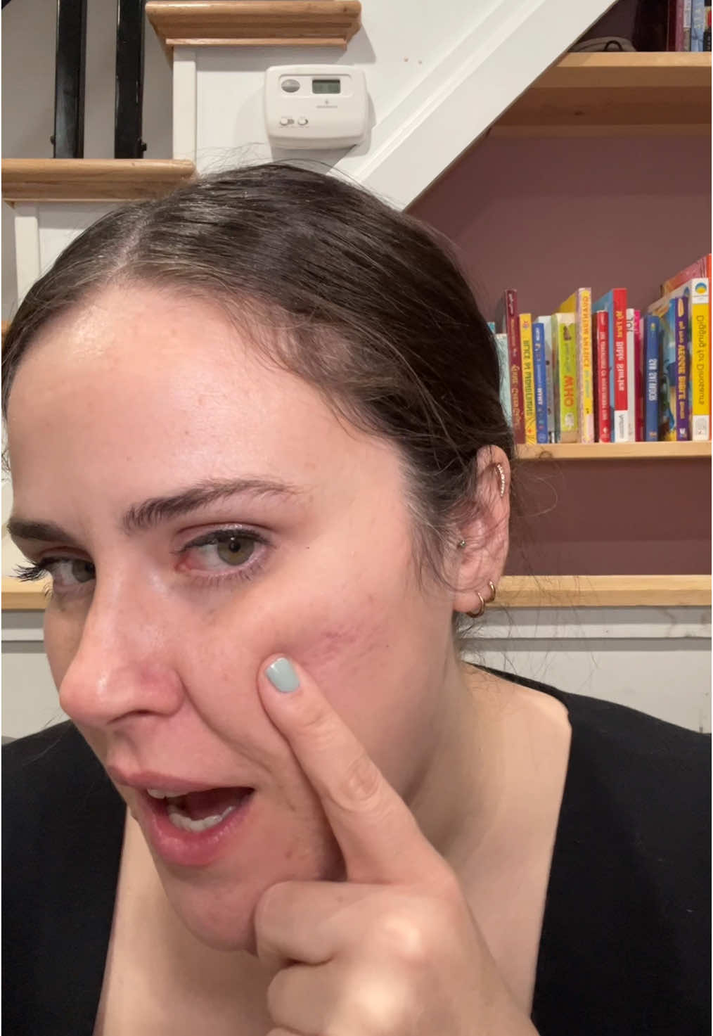 Fricken adult acne 🙄 like whennnnn does it stop!??  #acne #adultacne #acnescars 
