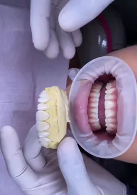 Giải pháp dành cho quý khách hàng sợ mài nhỏ răng 🥵#xh#xuhuongtiktok#nhakhoa #rangsuchinhhang #fypシ #cerconht #nhakhoauytin #nhakhoalamrangsudep #zirconia #lava #rangdep 