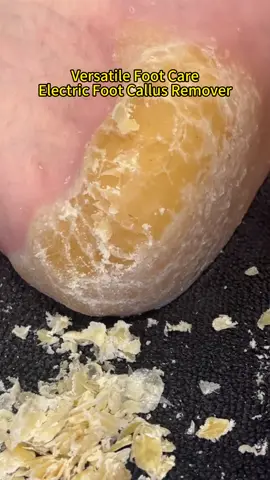 Electric Foot Callus Remover!!Salon-Quality - Pedicure at home#Beauty #foot #footfiles #footcallusremover #electricfootcallusremover #electricfootfie #callus #foryou #giftideas #giftsforwomen #earwax 