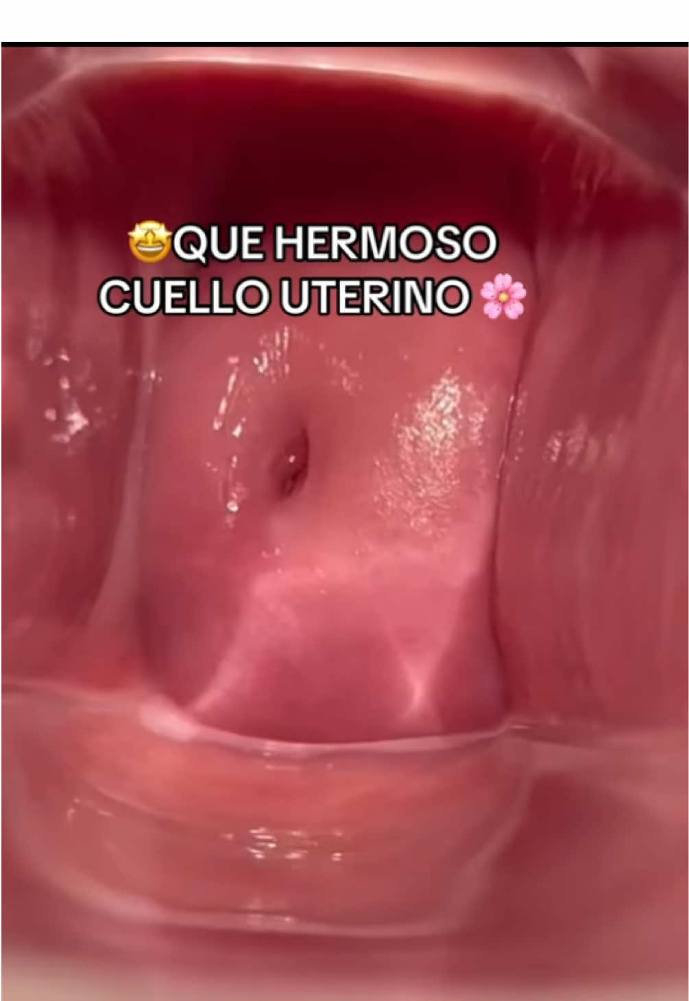 #candida #candidaalbicans #ginecologo #infeccionesurinarias #candidiasis #infeccionesurinarias #peru🇵🇪 #fyp 