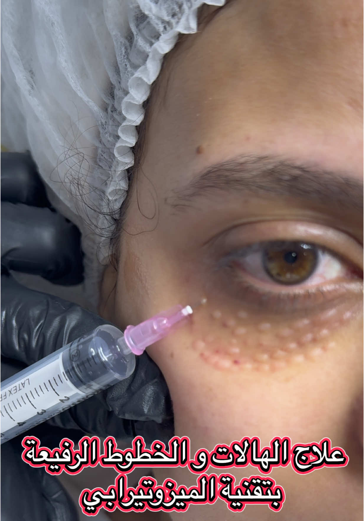 #جلديةوتجميل #تجميل_الوجه #ميزوثيرابي #جلديةوتجميل 