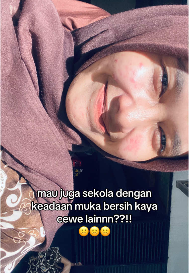 kapan? #fyp#foryou#trending#acne 