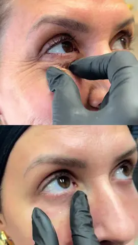 Resultado definitivo!! Já pensou em ter o olhos rejuvenescidos ?  Procedimento PERFEITO pra quem quer o rosto mais lisinho. Nesses casos, o BOTOX não vai resolver. Então precisamos passar por uma renovação celular (descamação), onde é possível tirar essa pele “velha” e incentivar a pele nova nascer! Dando aquele aspecto de “pele de bebê” nas áreas dos olhos.    #flacidezfacial #flacidez #olheiras #ata #peeling #lineskin #olheiras 