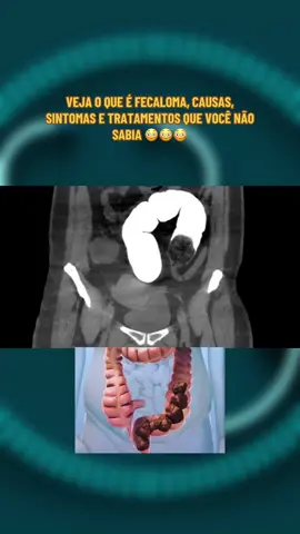 VEJA O QUE É FECALOMA, CAUSAS, SINTOMAS E TRATAMENTOS QUE VOCÊ NÃO SABIA 😳😳😳