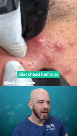 Get excited for some juicy blackhead extractions 🙌 (credit: @satisfying pimples ) #foryou #satisfying #blackhead