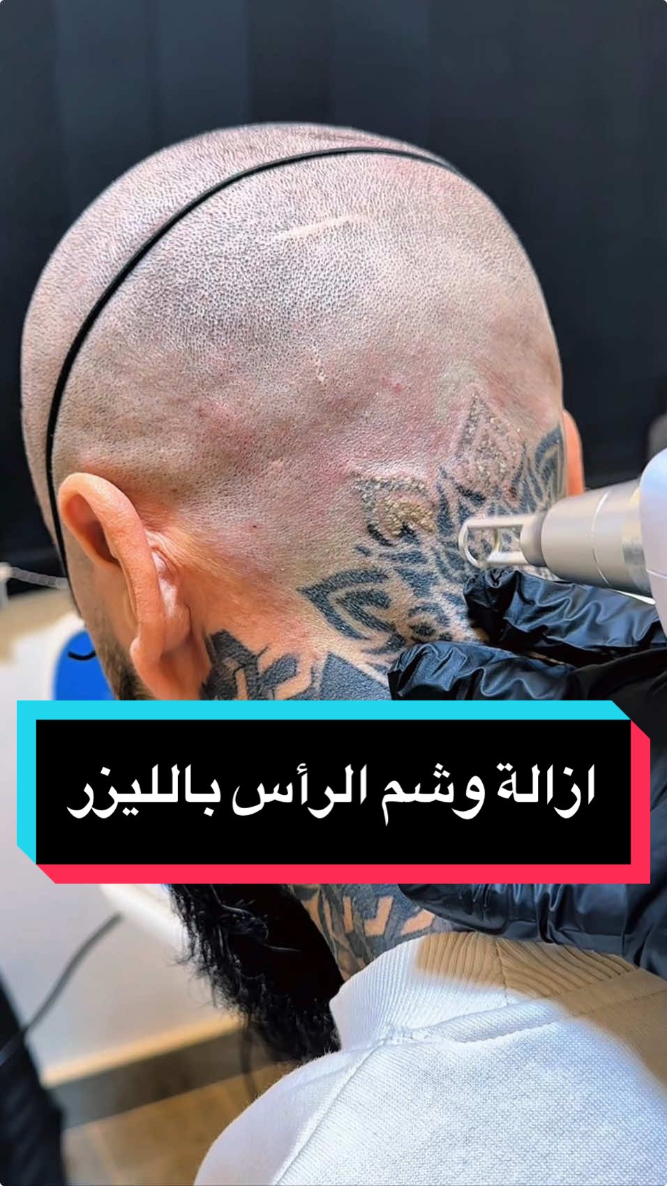 ازالة وشم الرأس بالليزر #mustielzein 