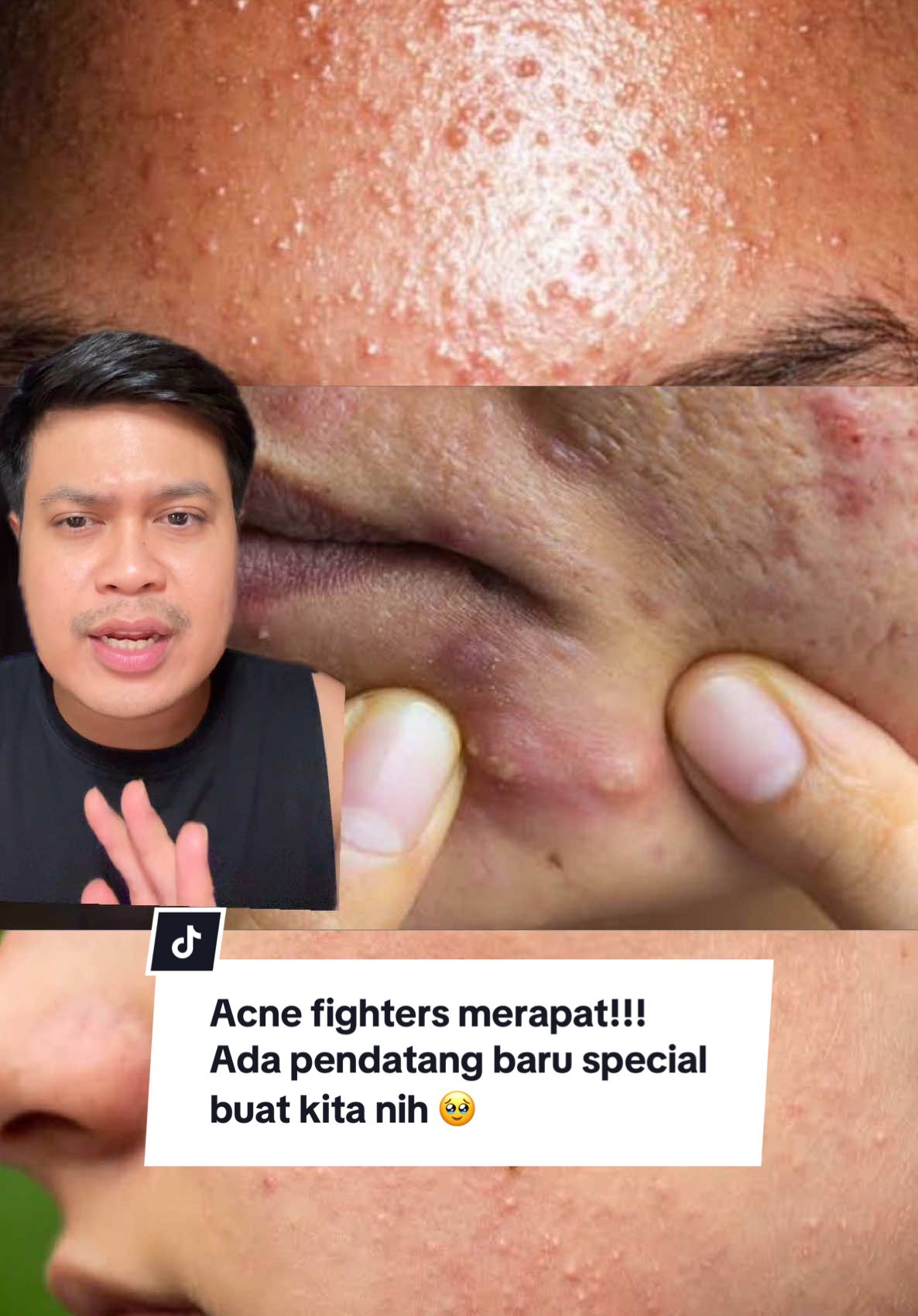 Akhirnya didengerin! Formulasinya nggak main-main diracik langsung sama dokter kecintaan kita loh. Buat temen-temen pejuang jerawat, recommended buat dicoba & semoga bermanfaat 🫶🏻 #p3kbuatjerawat #acnegencykit #facetology 