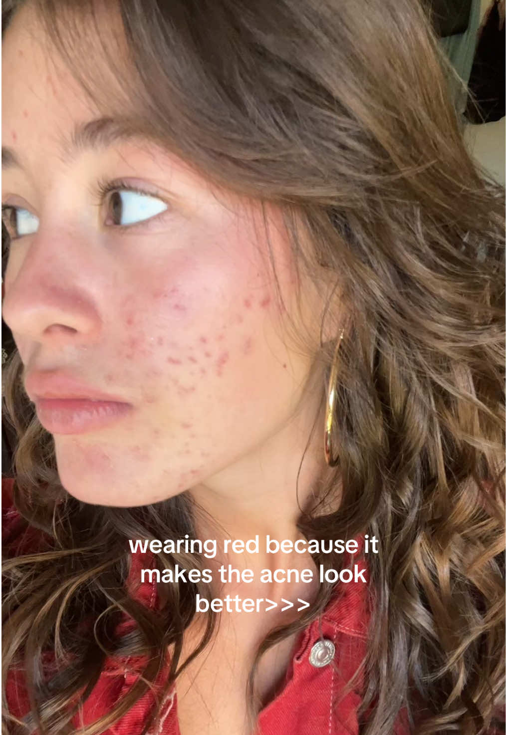 matches each other #acneskin #fypage #acnescars #nomakeup #ootdfashion #viraltiktok #acne 