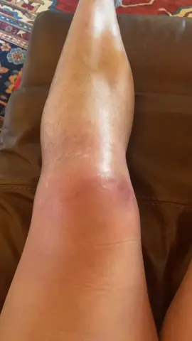 Day 2 patella rupture knee is super swollen. Surgery happening Tuesday. #fyp #patellatendon #kneesurgrey 